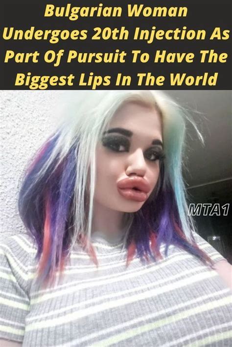 Bulgarian Woman Undergoes 20th Injection As Part Of Pursuit To Have The Biggest Lips In The