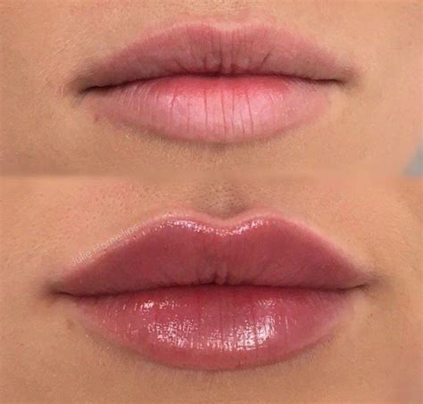 Maybe you would like to learn more about one of these? Dermal Fillers - Doctor in Lima, OH