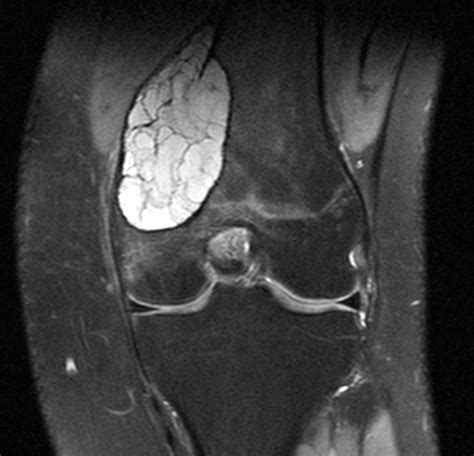 Аневризмальная костная киста Aneurysmal Bone Cyst Радиография