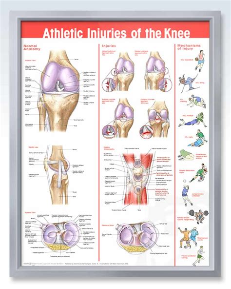Athletic Knee Injuries Anatomy Poster Clinicalposters