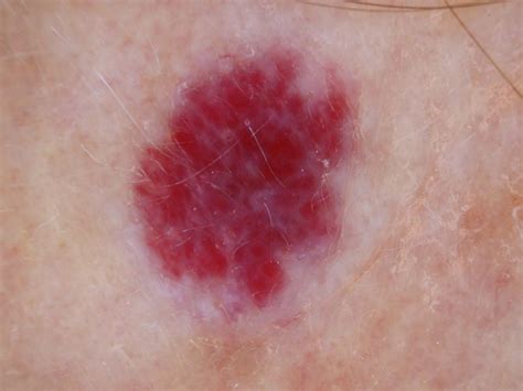 Cherry Angioma Causes And Treatment What Is A Cherry Angioma Causes