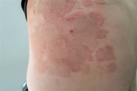 Erythema Photos Stock Photos Pictures And Royalty Free Images Istock