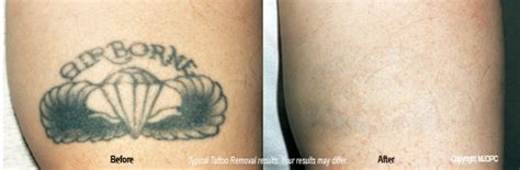 Ink eraser tattoo removal over all of the other tattoo removal spots in atlanta because they use the latest tattoo removal technology and because every one of their technicians have at least five years of medical experience. Atlanta Dermatology and Laser Surgery: Ditch Your Ugly Tattoo