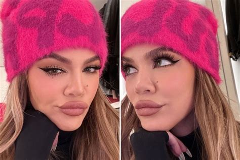 Khloe Kardashian Sparks Concern With Botched Lips That Look Like They