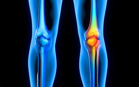 Pain Behind The Knee 6 Common Causes Effective Treatments