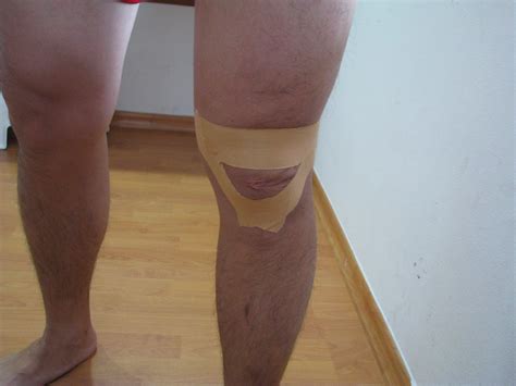 Knee Pain Fat Pad Irritation Or Hoffas Syndrome