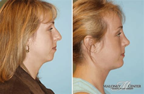 Facial Liposuction Gallery