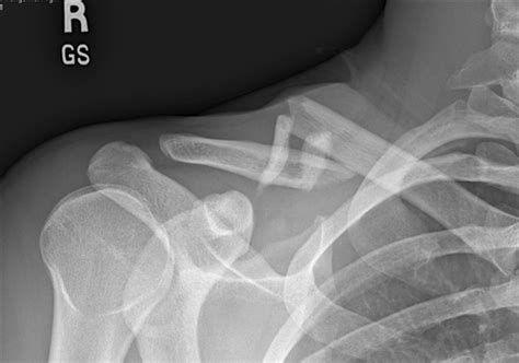 Acute Midshaft Clavicular Fracture Post Orthobullets
