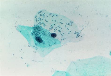 Lm Of Cervical Smear Showing Bacterial Infection Photograph By Science