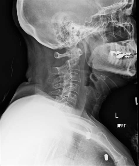 Dislocated Neck X Ray