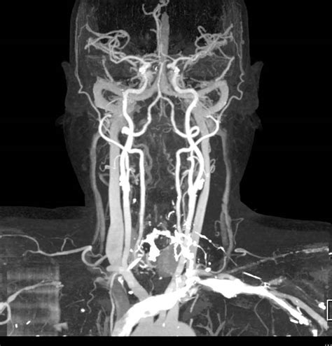 Cta Of The Neck With Dual Energy Bone Rmoval Neuro Case Studies