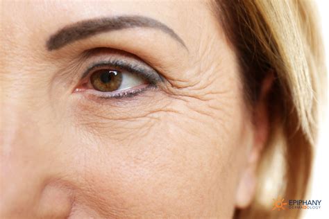 Are There Different Types Of Wrinkles Epiphany Dermatology