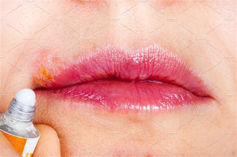 Herpes On The Lip Closeup Macro Woman Lubricates The Labial Herpes