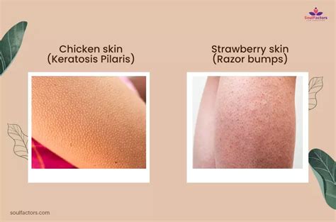 Keratosis Pilaris Chicken Skin Treatment That Works