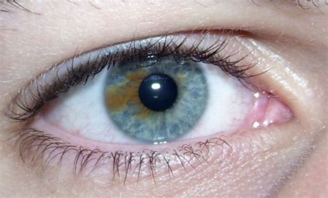 Sectoral Heterochromia Is A Condition In Which A Part Of One Iris Is A