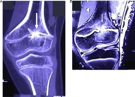 A Ct Scan Showing Physeal Bar In The Region Of Distal Femur Physis