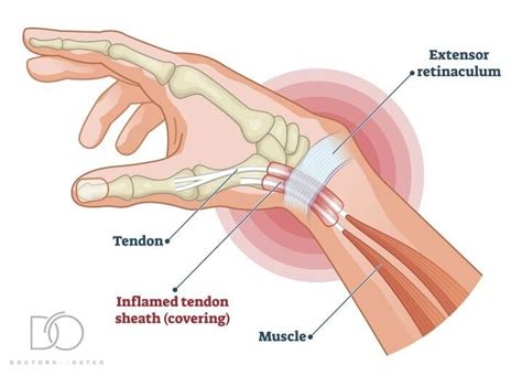 Osteo For De Quervains Tenosynovitis Thumb Pain Osteopath Hawthorn