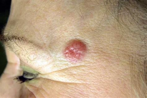 Basal Cell Carcinoma Bcc Is It On Your Radar Ausmed