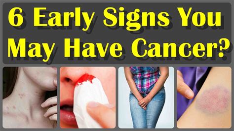 6 Early Signs You May Have Cancer And First Stage Cancer Symptoms Cancer Youtube