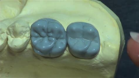Live Wax Up Upper 2nd Molarocclusion Youtube