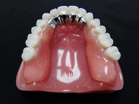 Upper Roofless Dentures