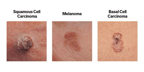 Types Of Skin Cancer Signs Treatment Risk Factors