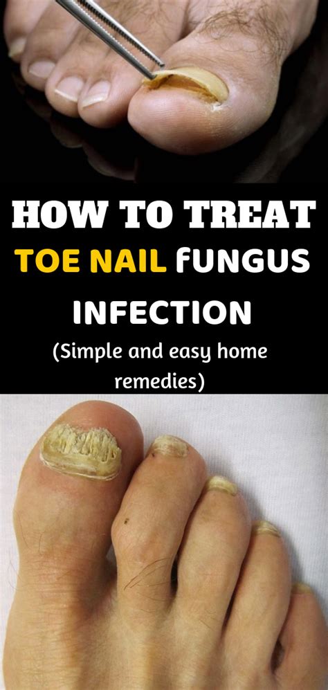 How To Treat Toe Nail Finger Infection With These Simple And Easy Home