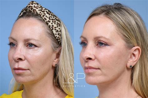Laser Skin Resurfacing Trl Before And After Photos By Drs