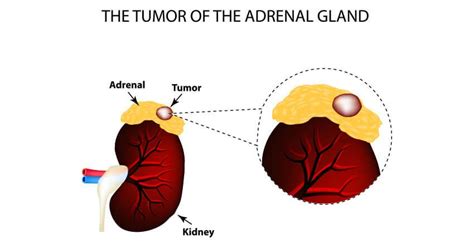 Adrenal Cancer Symptoms And Treatment Where Does Adrenal Cancer Spread