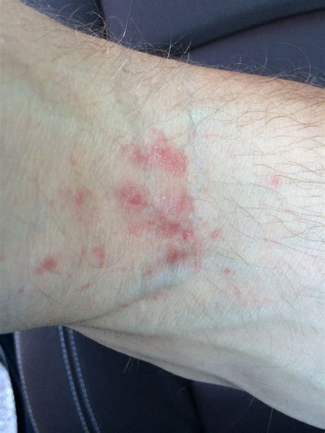 Itchy Elbow Rash Causes at Chana Ryan blog