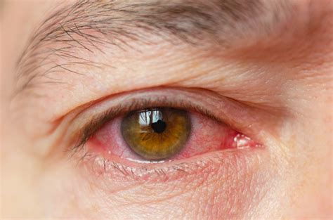 Closeup Irritated Infected Red Bloodshot Eyes Conjunctivitis Stock
