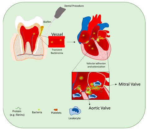 Bacterial Mouth Infections Overview Bacterial Endocarditis Secondary