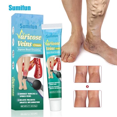 36x Varicose Veins Plaster Patch Vasculitis Phlebitis Spider Patch Leg