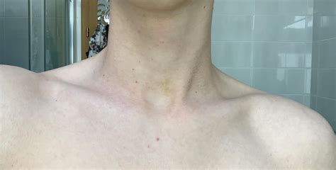 What Is This Yellow Spot On My Lower Neck Dermatologyquestions