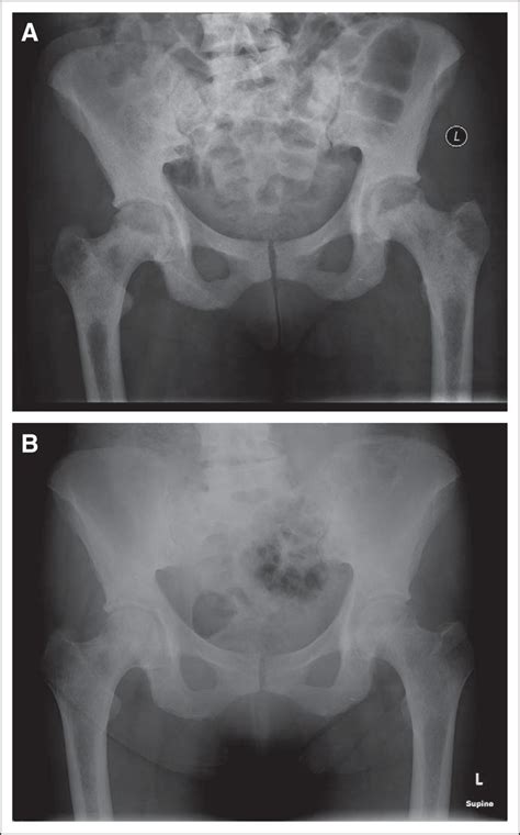Dramatic Response Of Diffuse Osteosclerosis Secondary To Multiple
