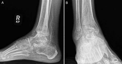 Blastomyces Tenosynovitis Of The Foot And Ankle A Case Report And