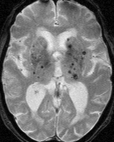 Cerebral Amyloid Angiopathy Ct And Mr Imaging Findings Radiographics
