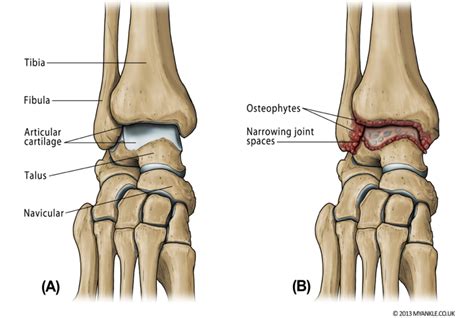 Ankle Arthritis — Ankle Arthritis Ankle Replacement Arthrodesis