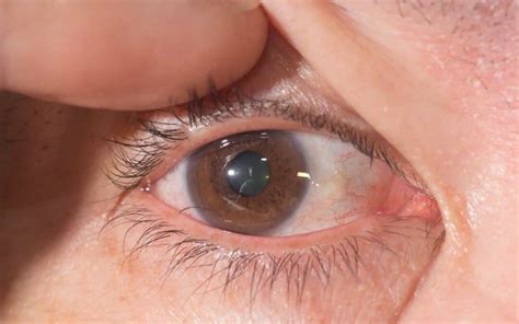Trichiasis Eye Health Library Bc Doctors Of Optometry