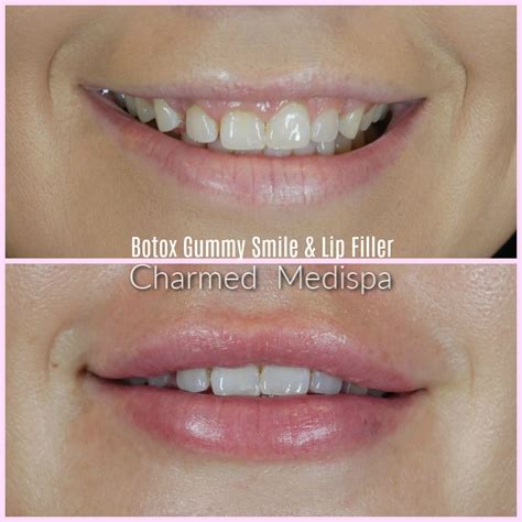 The gummy smile will be counted as an extra area with your regular treatment. Transforming Asymmetric Lips - Charmed Medispa