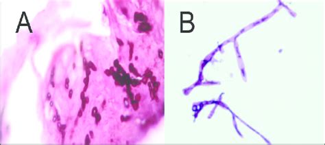 Pleural Effusion Cytological Smear Showing A Madurella Mycetomatis