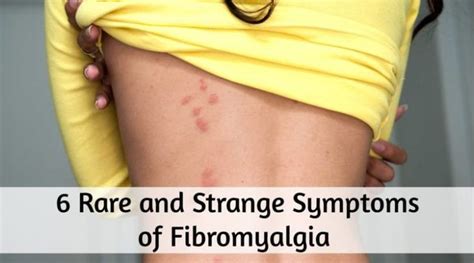 Rare And Strange Symptoms Of Fibromyalgia Med Line Plus