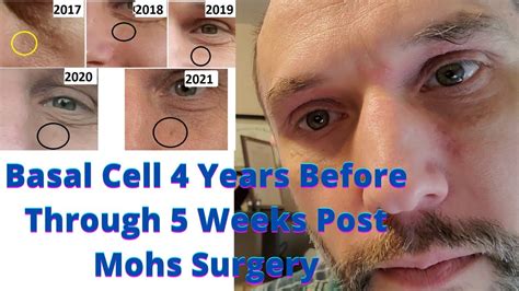 Mohs Surgery And Basal Cell 4 Years Before To 5 Weeks After Surgery