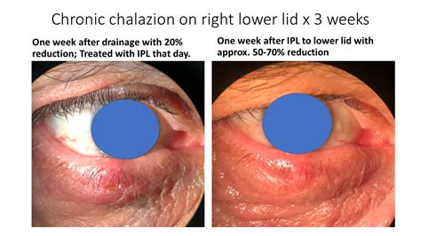 Intense Pulse Light | Dry Eye Disease Treatment | Glen Allen, VA