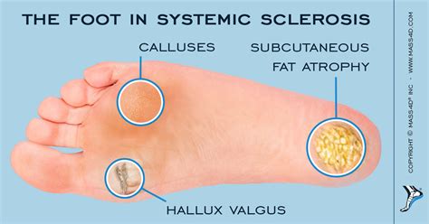 Foot Problems In Systemic Sclerosis Mass4d® Foot Orthotics