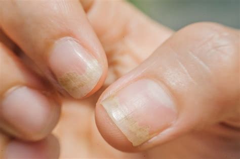 What Are The Signs Of Nail Fungus Tutorial Pics