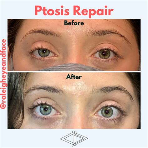 Check spelling or type a new query. Ptosis Repair - Raleigh Eye and Face Plastic Surgery