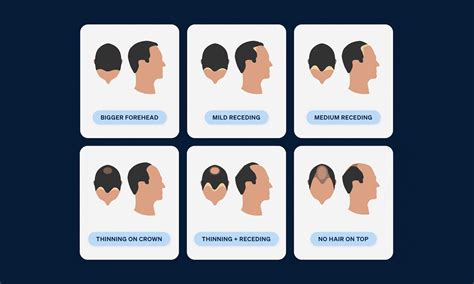 The 7 Receding Hairline Stages Explained Pilot
