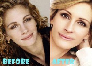 Julia Roberts Plastic Surgery Before And After Pictures Lovely Surgery