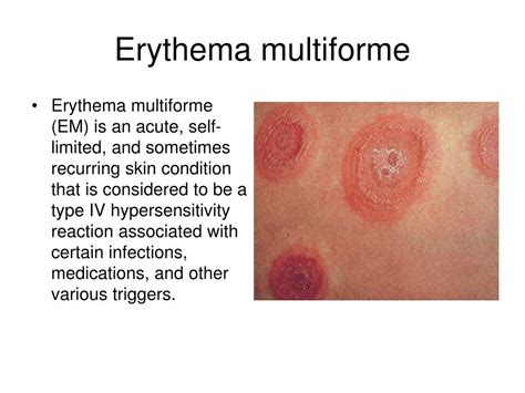 Ppt Allergic Diseases Powerpoint Presentation Free Download Id6155917